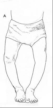 膝内翻