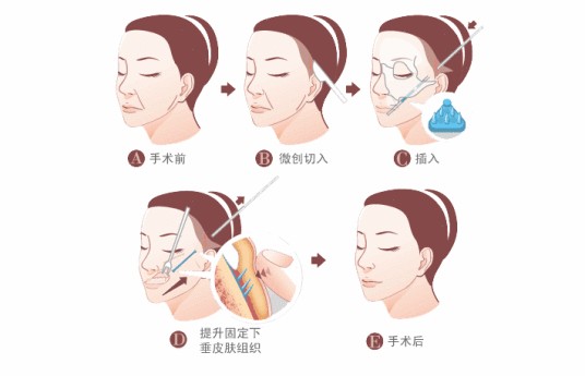 锯齿线悬吊除皱术