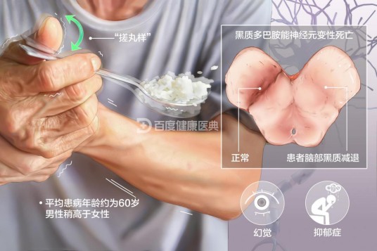 帕金森病(一种常见的神经系统变性疾病)