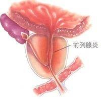 滴虫性前列腺炎