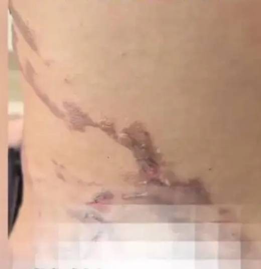 7·4武汉女子拔罐被烧伤事件