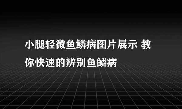 小腿轻微鱼鳞病图片展示 教你快速的辨别鱼鳞病