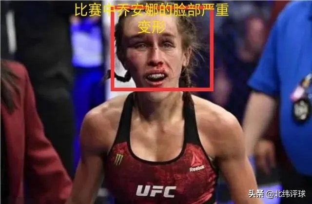 UFC冠军赛后,乔安娜需要进行整形手术而张伟丽却完全不需要,这是为什么?你怎么看?