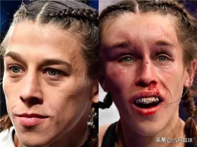 UFC冠军赛后,乔安娜需要进行整形手术而张伟丽却完全不需要,这是为什么?你怎么看?