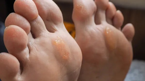 足癣怎么治疗