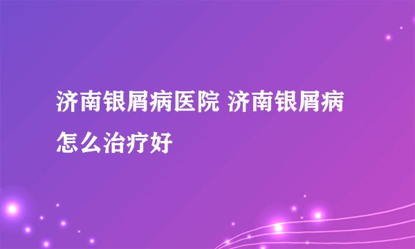 济南银屑病医院 济南银屑病怎么治疗好