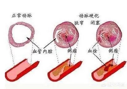血管堵塞,身体会发出哪些求救信号?吃什么食物可以疏通血管?