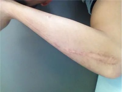 如何去除手术疤痕