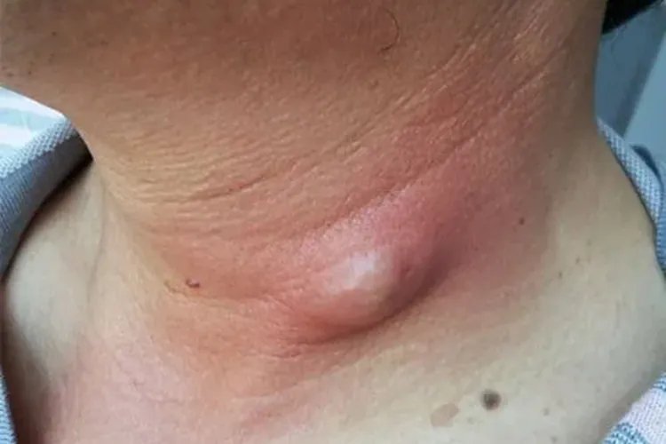 颈部长疙瘩图片
