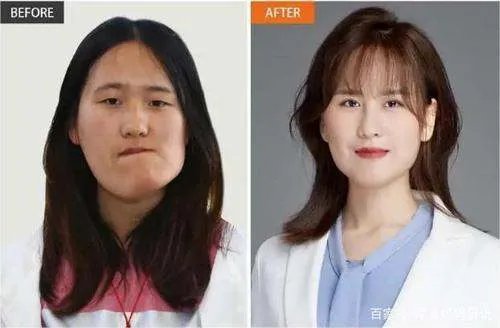 歪脸女孩赵宏秋整容成功后舍百万年薪当老师,后来怎样了?