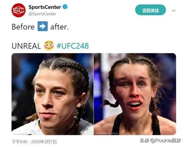 UFC冠军赛后,乔安娜需要进行整形手术而张伟丽却完全不需要,这是为什么?你怎么看?