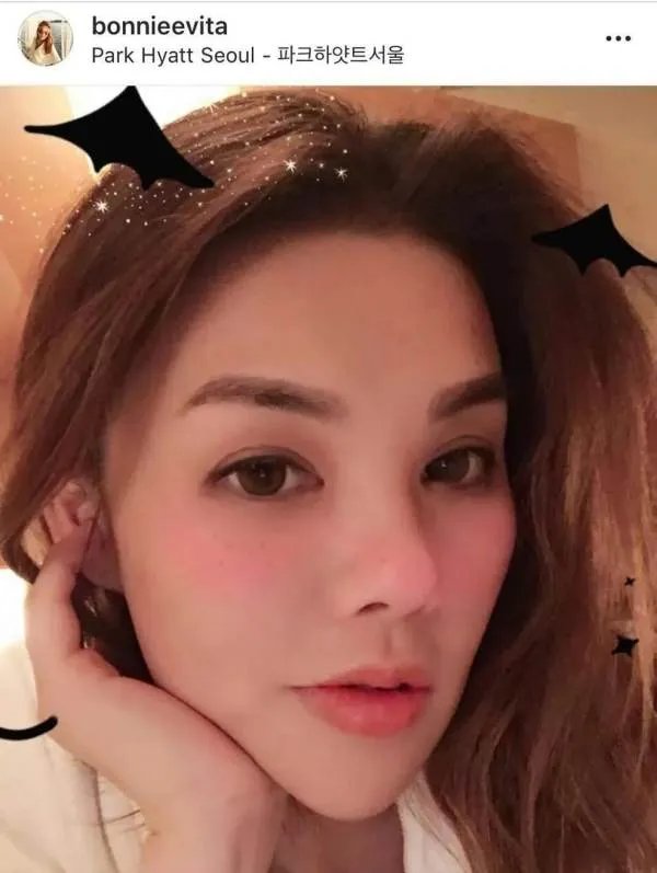 女子微整失败后崩溃，有哪些知名人物是因为整容死亡的？