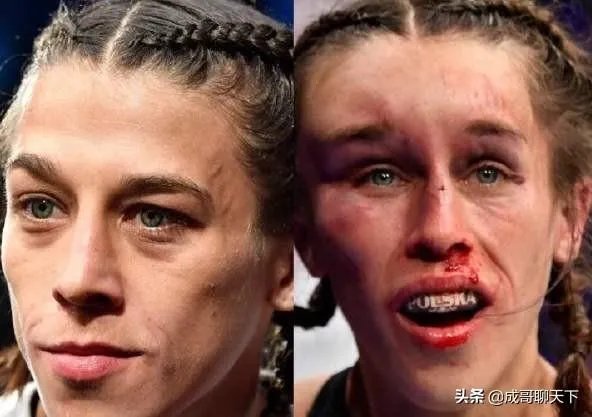 UFC冠军赛后,乔安娜需要进行整形手术而张伟丽却完全不需要,这是为什么?你怎么看?
