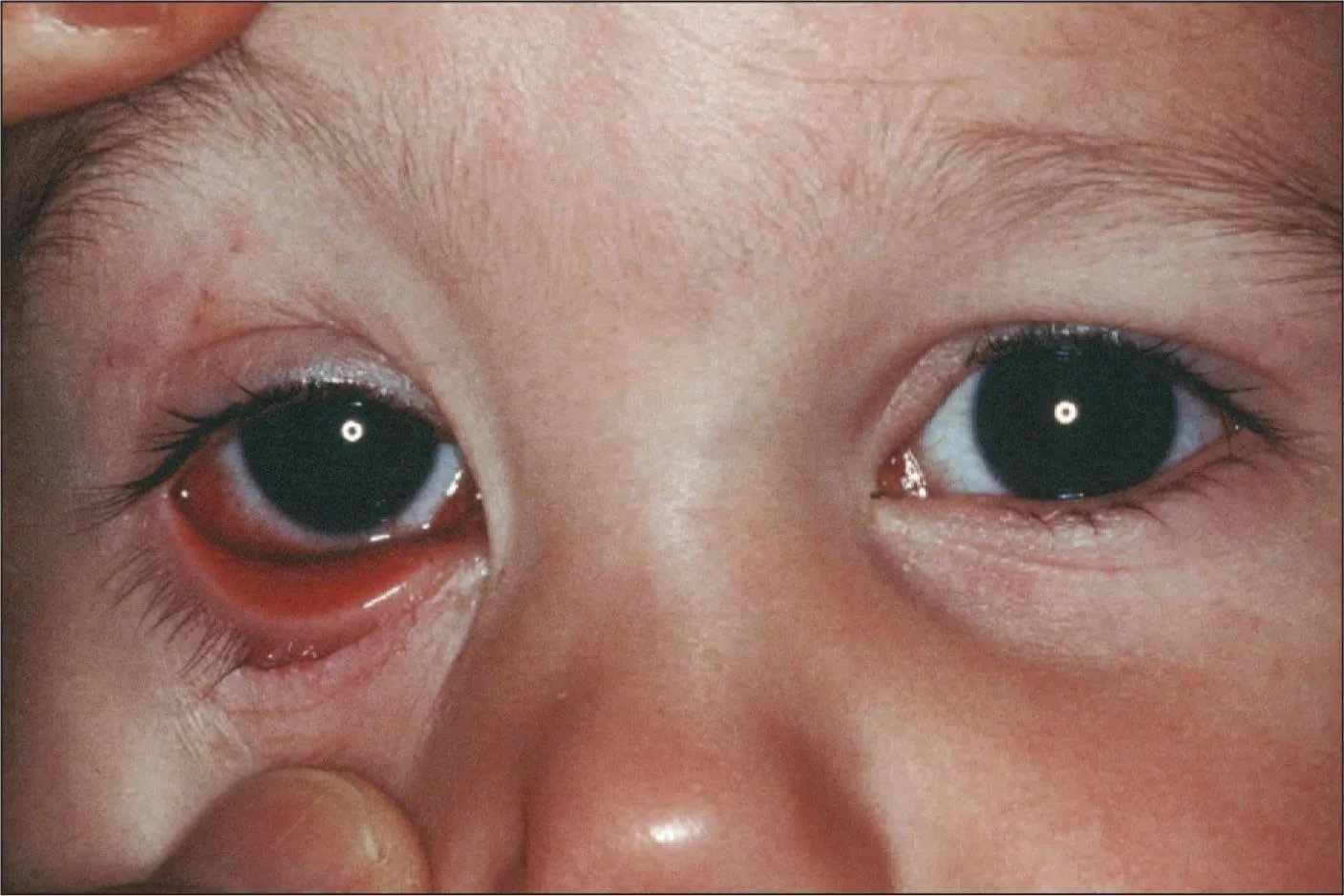 眼睛疾病大全图解